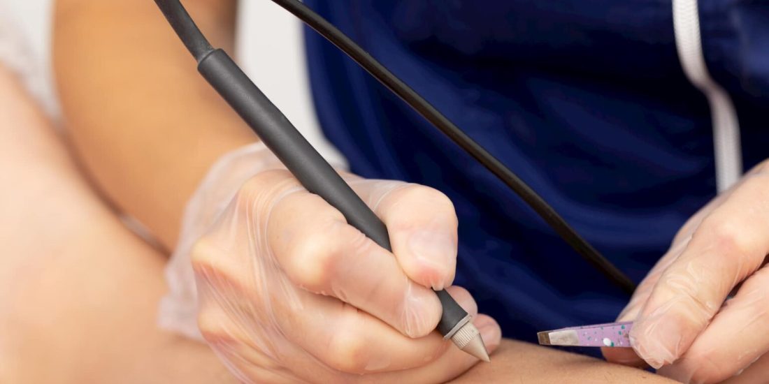 İğneli Lazer Epilasyon