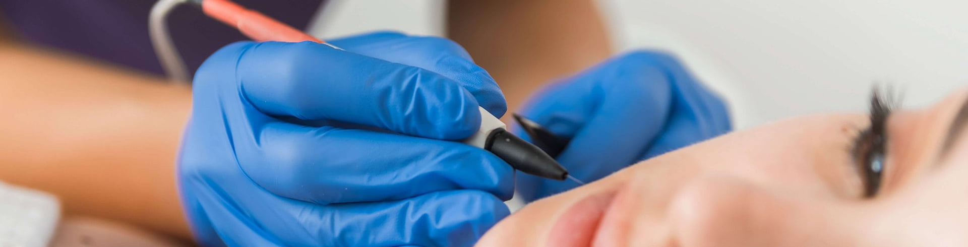 İğneli Lazer Epilasyon