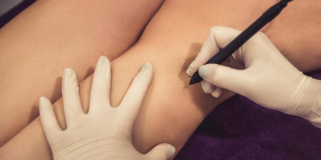 Pendik İğneli Epilasyon