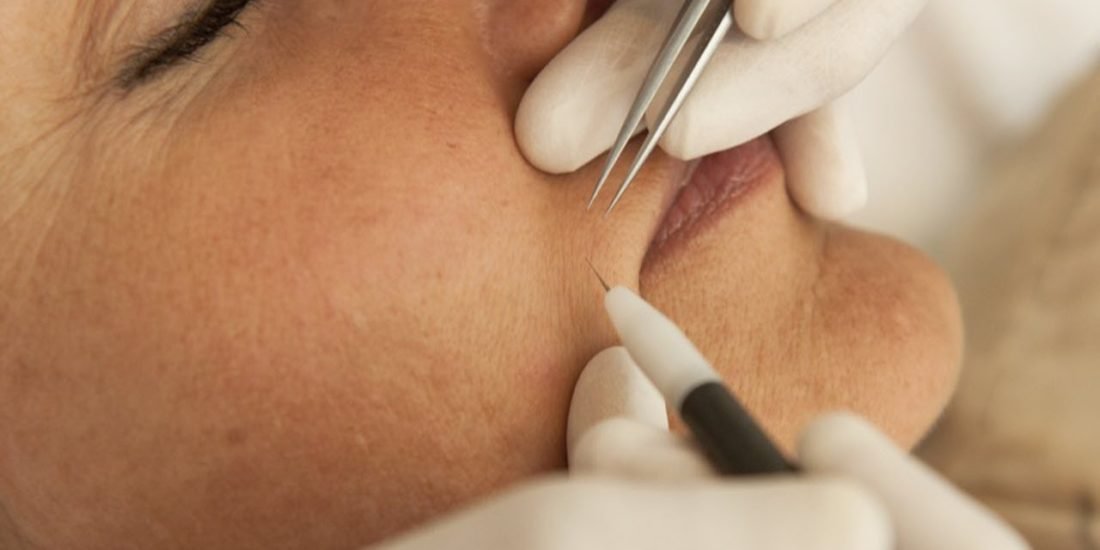 Pendik İğneli Lazer Epilasyon