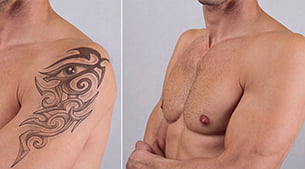 Pico Lazer Dövme Silme