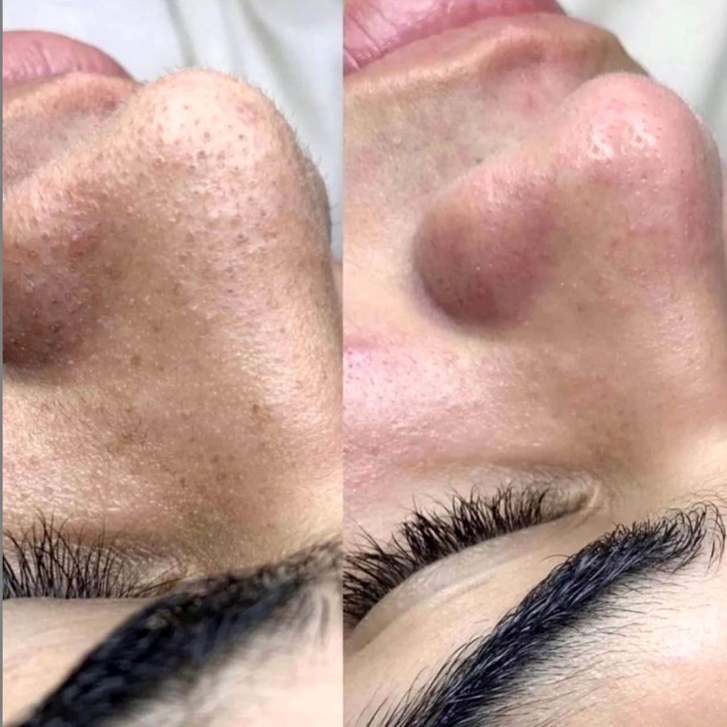 Hydrafacial Öncesi Sonrası