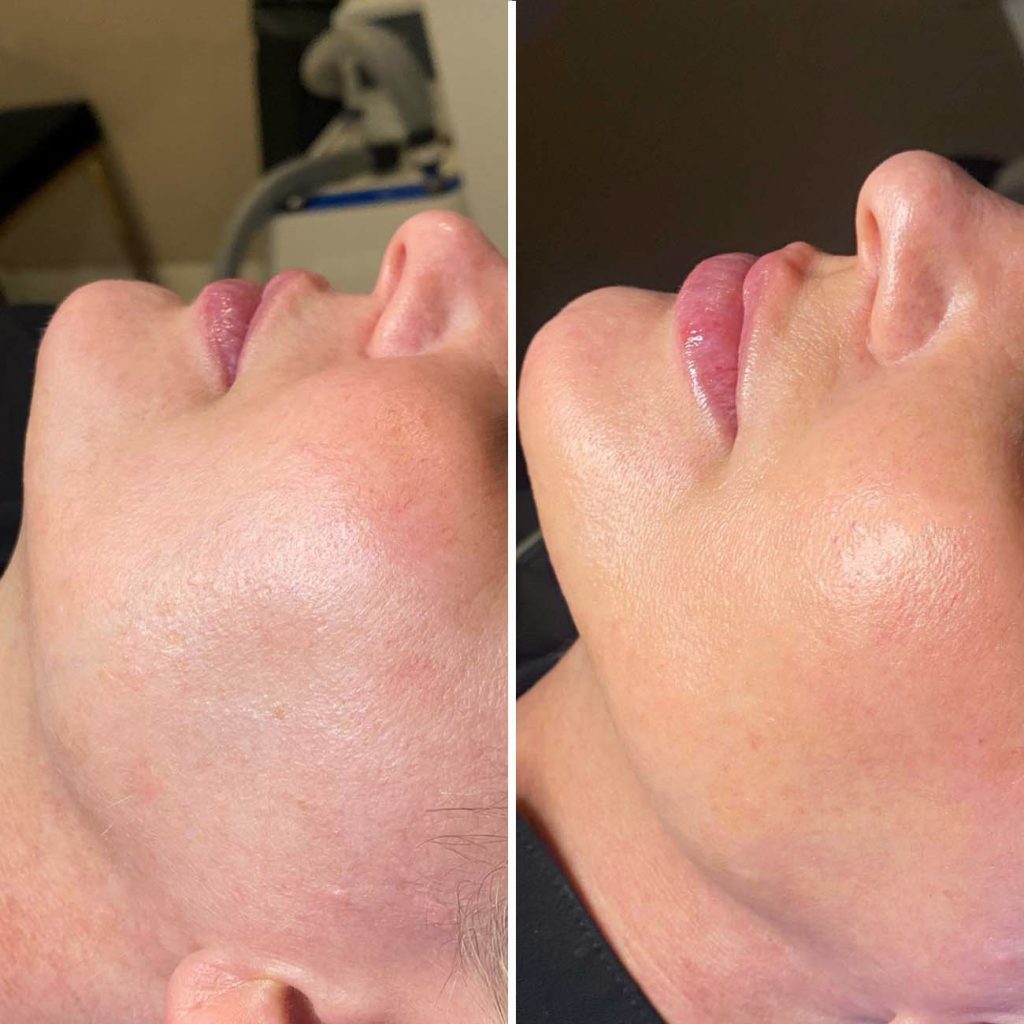 Hydrafacial Yaptıranlar