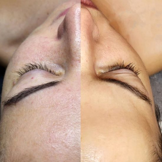 Karbon Peeling Öncesi