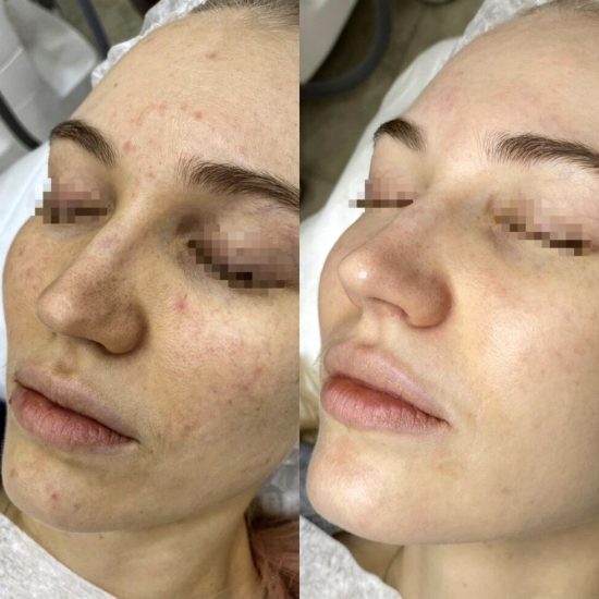 Karbon Peeling Öncesi-Sonrası