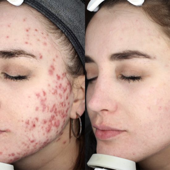 Karbon Peeling Sonrası