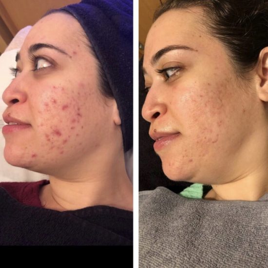 Karbon Peeling Sonrası-Öncesi