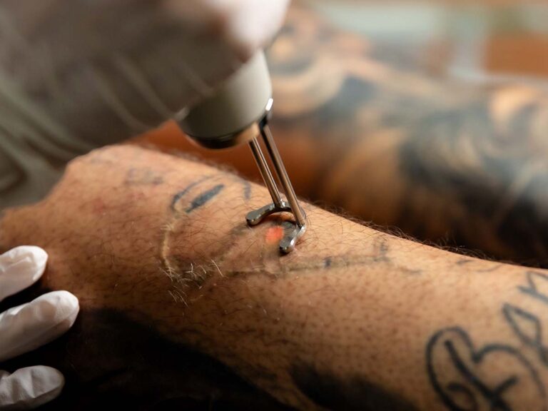 Pico Lazer Dövme Silme